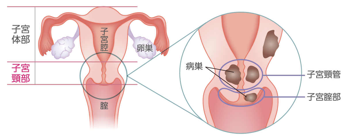 子宮体部‐子宮腔・卵巣 子宮頚部‐頸管部・子宮膣部に病巣
