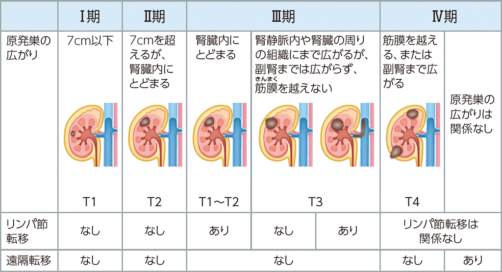 腎細胞がんの病期分類（TNM分類）