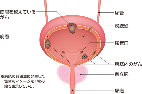 膀胱がんの発生