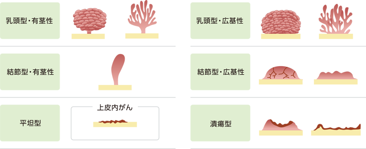 膀胱がんの形態の模式図