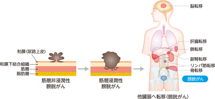 尿路上皮がんの進行の様子