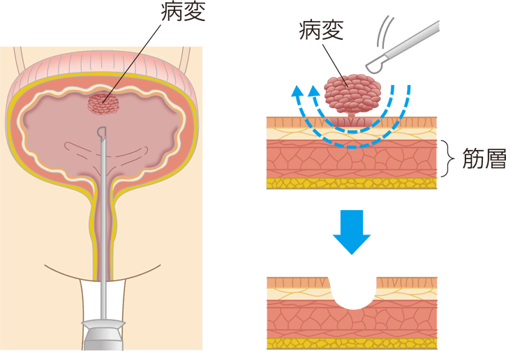 経尿道的膀胱腫瘍切除術の方法