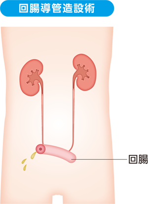 尿路変向術の例