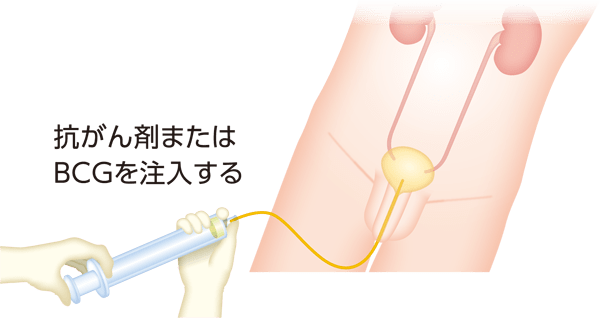 膀注療法のイメージ