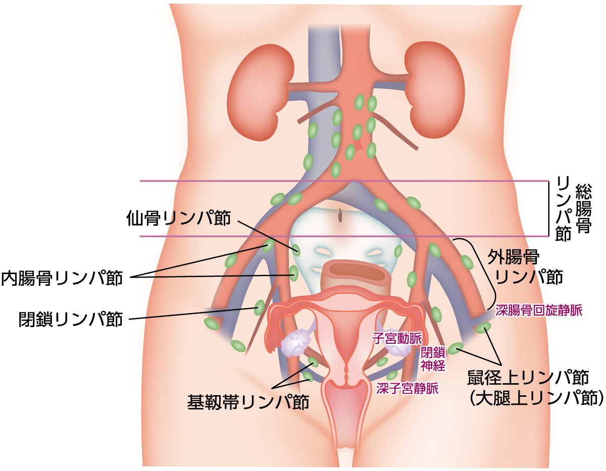 子宮頸がんの手術 子宮頸がん Msd Oncology がんを生きる