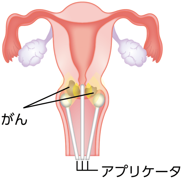 膣内照射