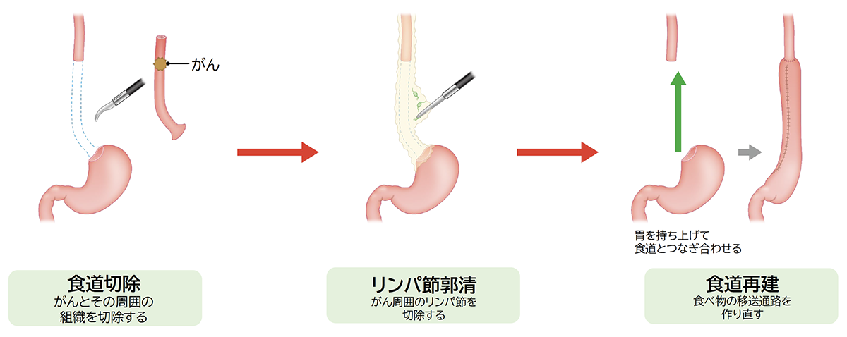 合併症やリスクは何ですか?