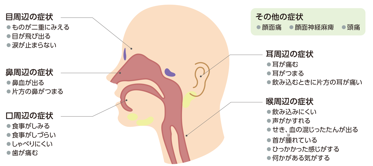 頭頸部がんのおもな症状