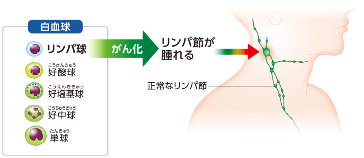 ホジキンリンパ腫進行の特徴