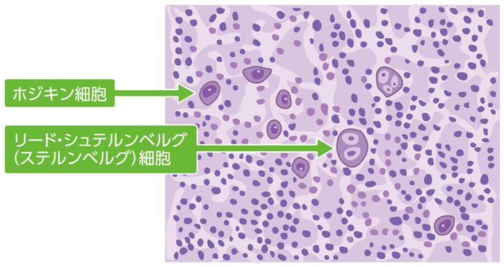 ホジキンリンパ腫のリンパ節の組織