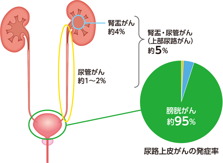 尿路上皮がんの部位別発症率