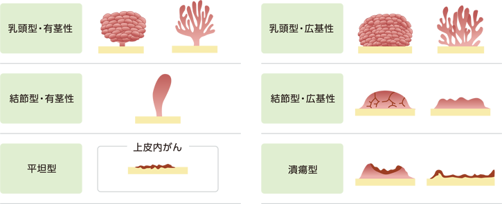 尿路上皮がんの形態の模式図