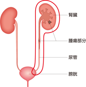 腎尿管全摘除術