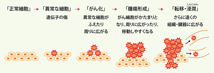 「正常細胞」 ↓ 「異常な細胞」遺伝子の傷 ↓ 「がん化」異常な細胞が増えたり周りに広がる ↓ 「腫瘍形成」がん細胞がかたまりとなり、周りに広がったり、移動しやすくなる ↓ 「転移・浸潤」さらに遠くの組織・臓器に広がる