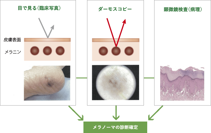 メラノーマの診断のために必要な検査 | 検査・診断 | MSD oncology が