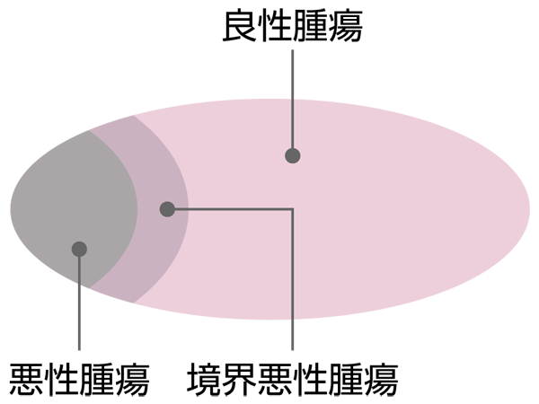 卵巣腫瘍の種類