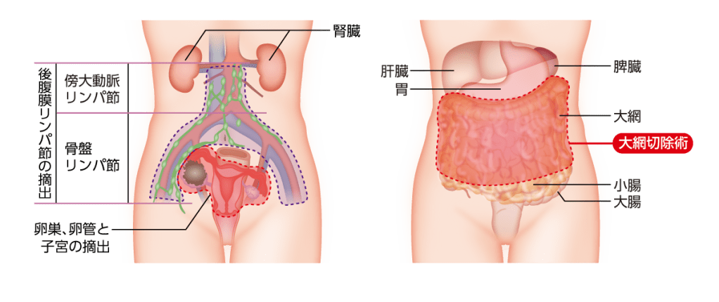 卵巣がんの手術範囲