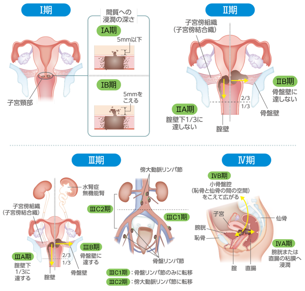 I期（子宮頚部） 間質への浸潤の深さ　IA期：5mm以下　IB期：5mmをこえる II期（子宮傍組織・子宮傍結合織） IIA期：膣壁下1/3に達しない　IIB期：骨盤壁に達しない III期 IIIA期：膣壁下1/3に達する　IIIB期：骨盤壁に達する　IIIC1期：骨盤リンパ節のみに転移　IIIC2期：傍大動脈リンパ節に転移 IV期 IVA期：膀胱または直腸の粘膜へ浸潤　IVB期：小骨盤腔（恥骨と仙骨の間の空間）を超えて広がる