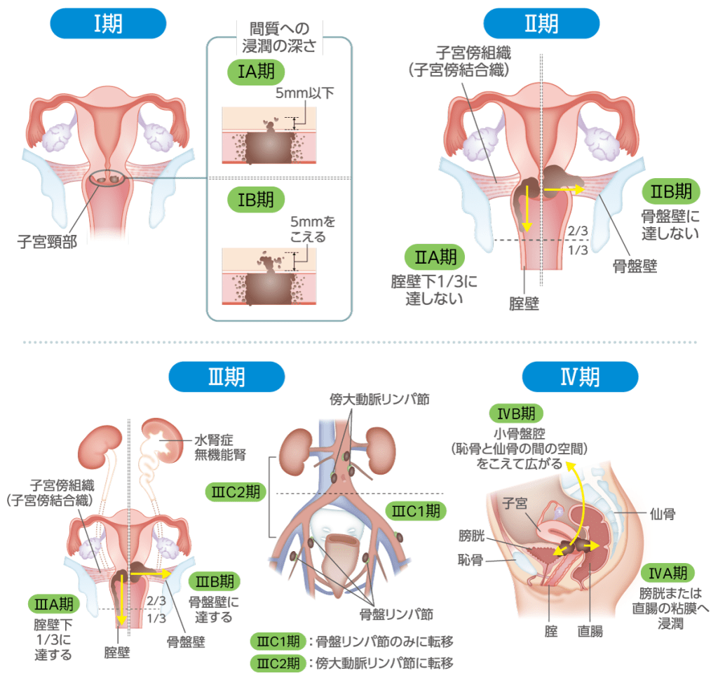 I期(子宮頚部) 間質への浸潤の深さ IA期:5mm以下 IB期:5mmをこえる II期(子宮傍組織・子宮傍結合織) IIA期:膣壁下1/3に達しない IIB期:骨盤壁に達しない III期 IIIA期:膣壁下1/3に達する IIIB期:骨盤壁に達する IIIC1期:骨盤リンパ節のみに転移 IIIC2期:傍大動脈リンパ節に転移 IV期 IVA期:膀胱または直腸の粘膜へ浸潤 IVB期:小骨盤腔(恥骨と仙骨の間の空間)を超えて広がる