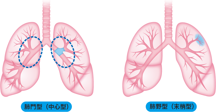 肺門型（中心型）と肺野型（末梢型）