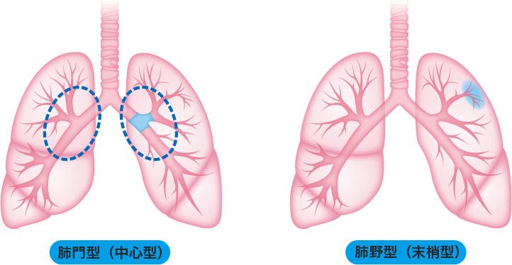 肺門型(中心型)と肺野型(末梢型)