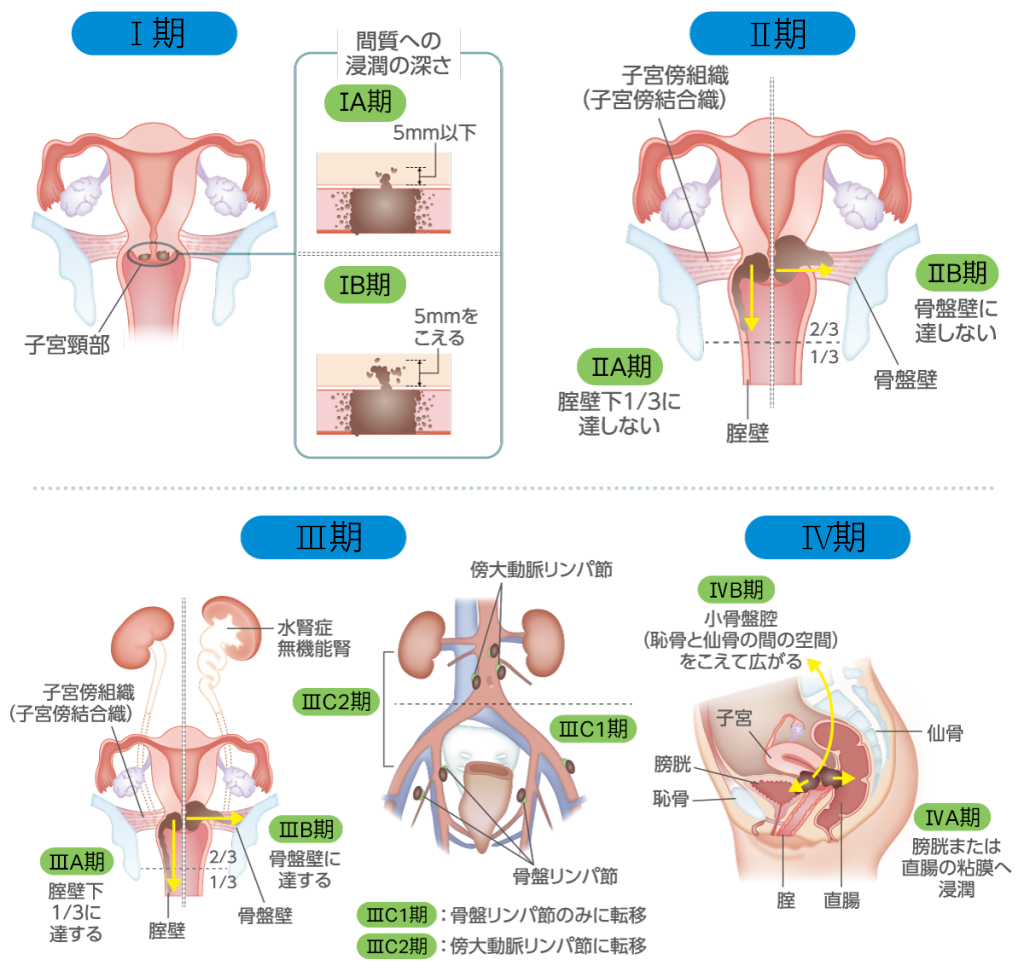 I期（子宮頚部） 間質への浸潤の深さ　IA期：5mm以下　IB期：5mmをこえる II期（子宮傍組織・子宮傍結合織） IIA期：膣壁下1/3に達しない　IIB期：骨盤壁に達しない III期 IIIA期：膣壁下1/3に達する　IIIB期：骨盤壁に達する　IIIC1期：骨盤リンパ節のみに転移　IIIC2期：傍大動脈リンパ節に転移 IV期 IVA期：膀胱または直腸の粘膜へ浸潤　IVB期：小骨盤腔（恥骨と仙骨の間の空間）を超えて広がる