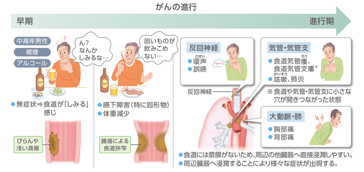 進行にともなってあらわれる食道がんの症状