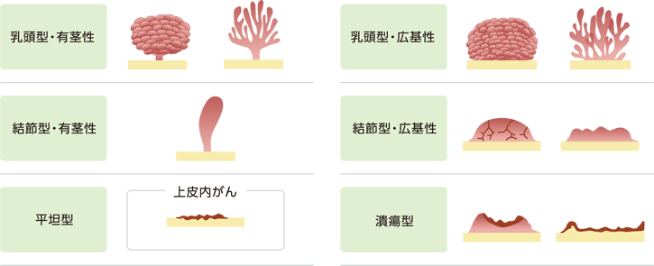 膀胱がんの形態の模式図