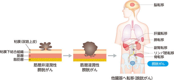 尿路上皮がんの進行の様子