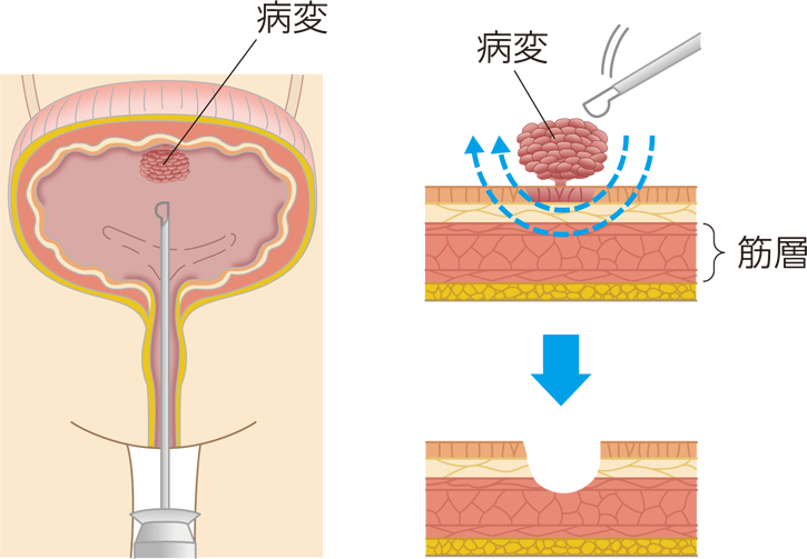 経尿道的膀胱腫瘍切除術の方法