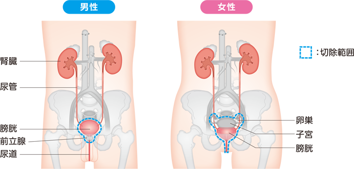 膀胱全摘除術でとりのぞく範囲