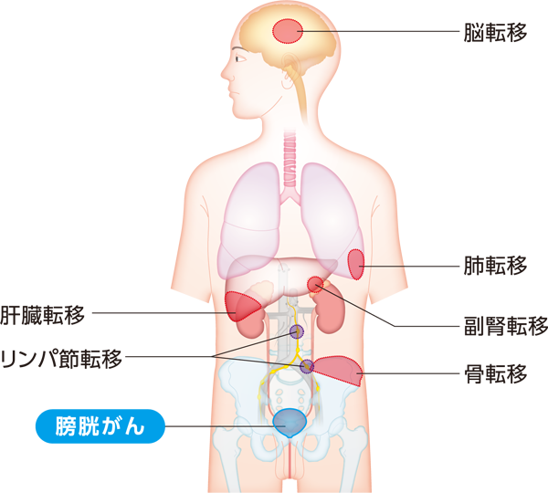 転移しやすい場所と症状