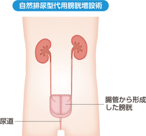自然排尿型代用膀胱造設術