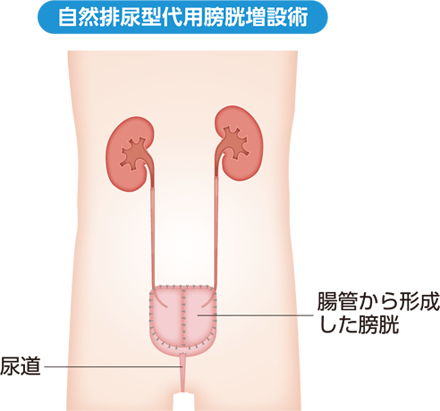 自然排尿型代用膀胱造設術