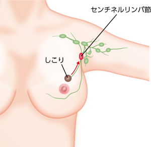 センチネルリンパ節イメージ