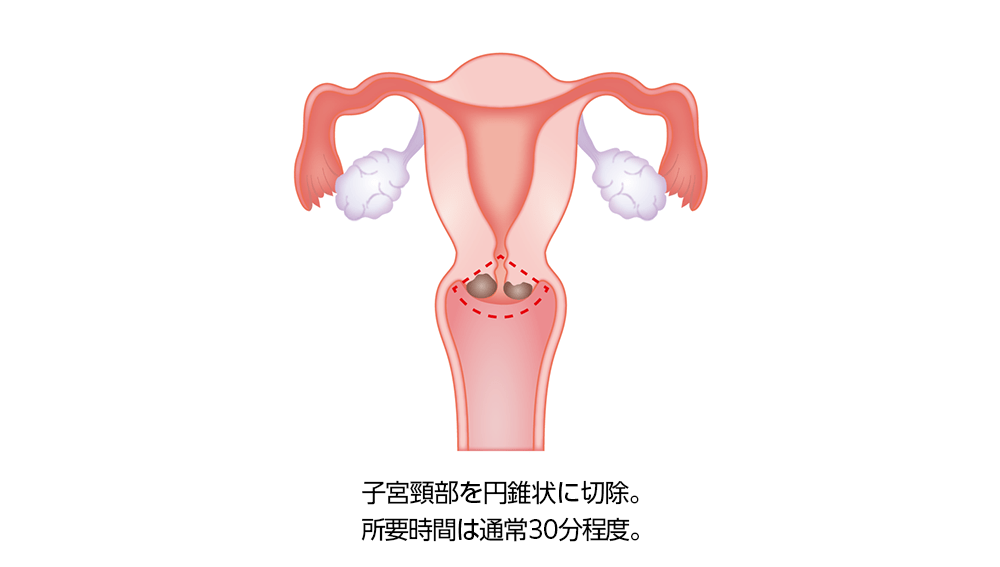 子宮頸部円錐切除術（しきゅうけいぶえんすいせつじょじゅつ）
