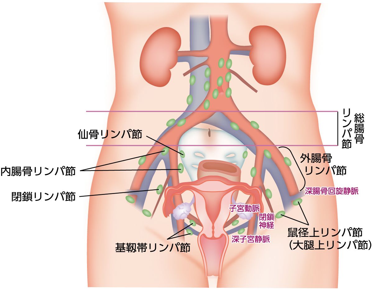 子宮がん治療に関係するリンパ節と名称