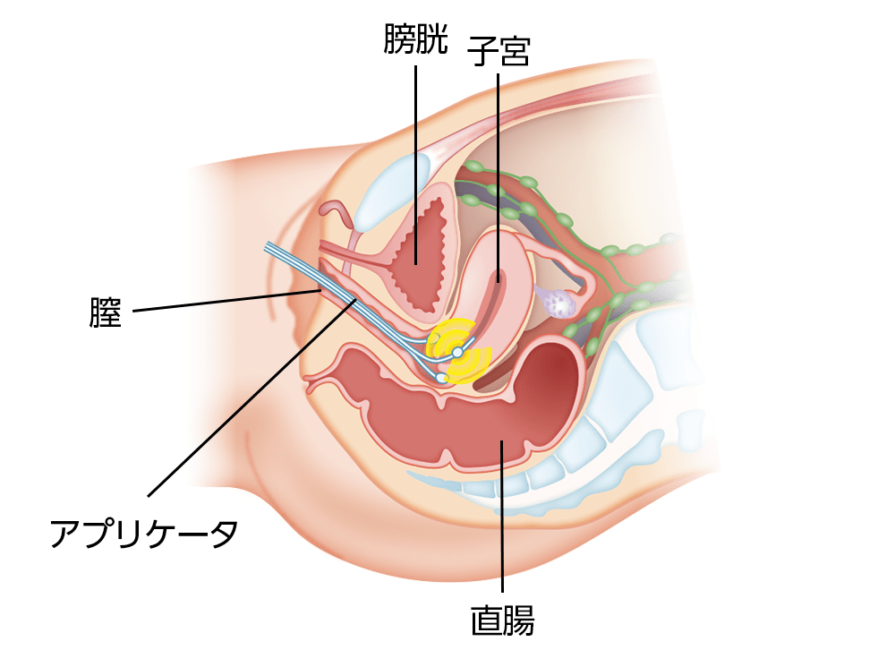 腔内照射