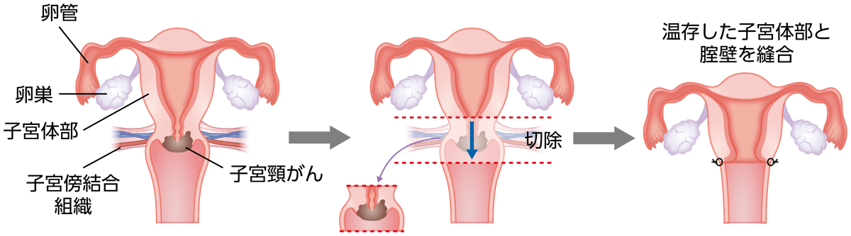 広汎子宮頸部摘出術