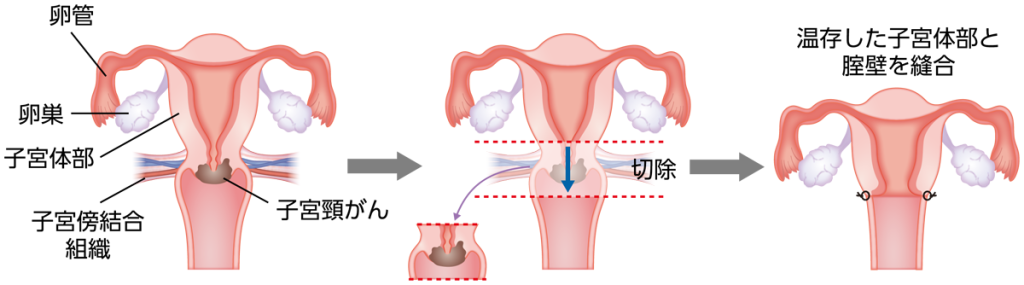 妊娠の可能性を保持するための治療法 | 子宮頸がん | MSD oncology が 妊娠の可能性を保持するための治療法 | 子宮頸がん | MSD oncology が