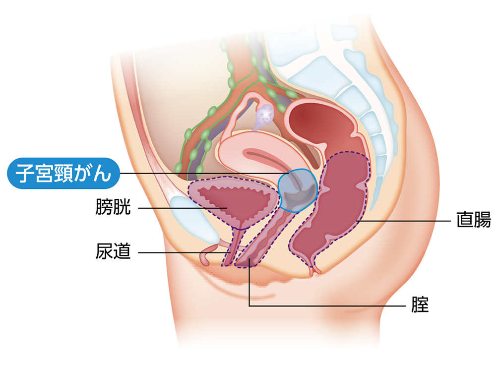 子宮頸がんの骨盤内再発が起こりやすい場所