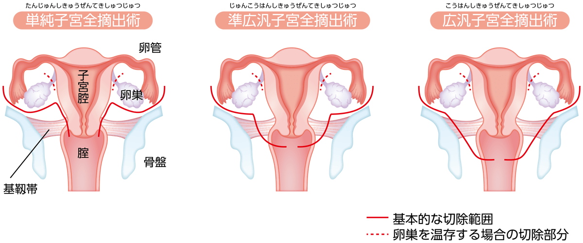 子宮全摘出術