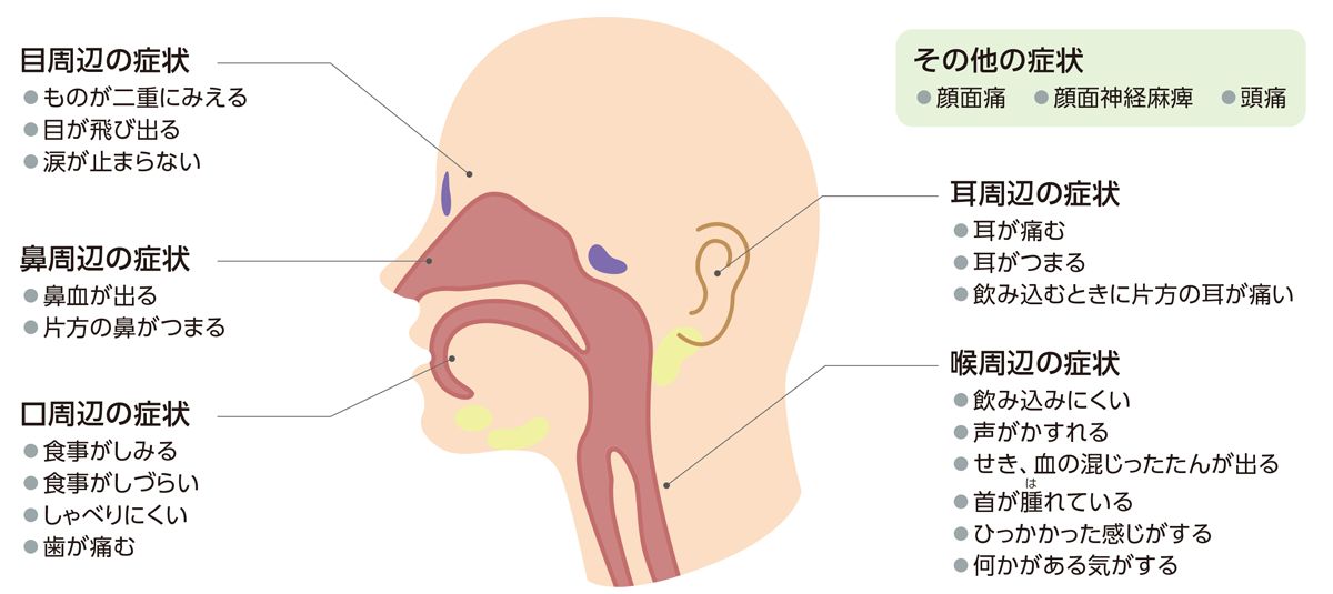 頭頸部がんのおもな症状