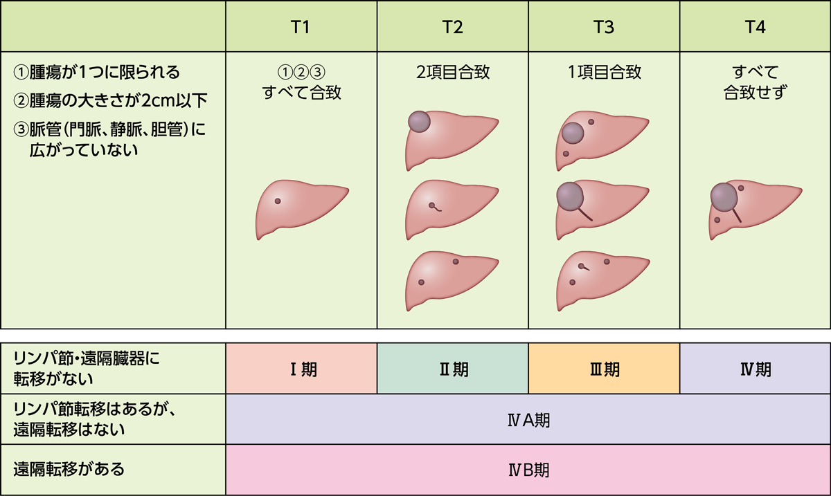 肝細胞がんの病期分類の表