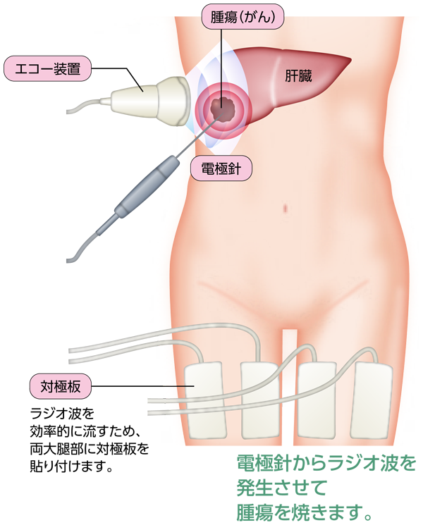 ラジオ波焼灼療法のイメージ