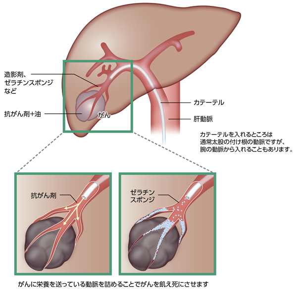 肝動脈化学塞栓療法及び肝動脈塞栓療法のイメージ