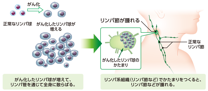 ホジキンリンパ腫の発症のしかた