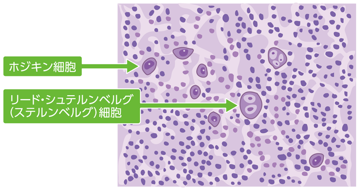 ホジキンリンパ腫のリンパ節の組織