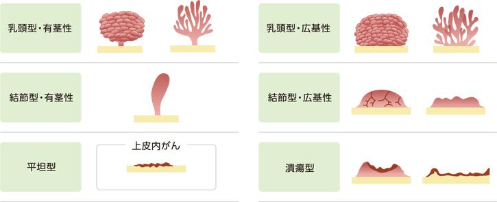 尿路上皮がんの形態の模式図