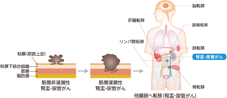 尿路上皮がんの進行の様子
